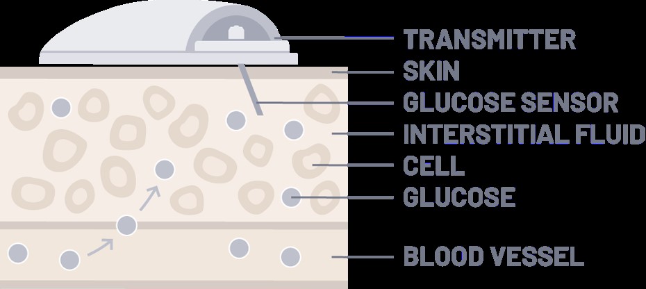 如何使用動態(tài)血糖監(jiān)測設(shè)備(CGM)管理糖尿病 如何使用動態(tài)血糖監(jiān)測設(shè)備(CGM)管理糖尿病